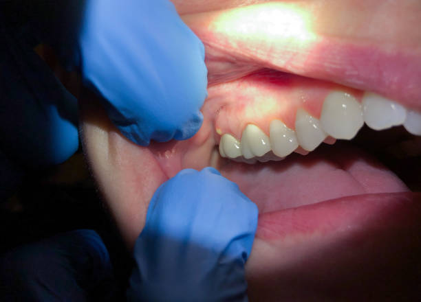 Best Dentist for Tooth Abscess  in Riverwoods, IL